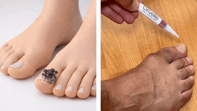 Applying a natural oil treatment to a discolored toenail with a pen-style applicator to fight nail fungus